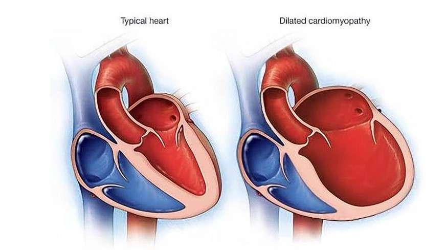 Identifican por primera vez el riesgo de miocardiopatía dilatada en los portadores genéticos
